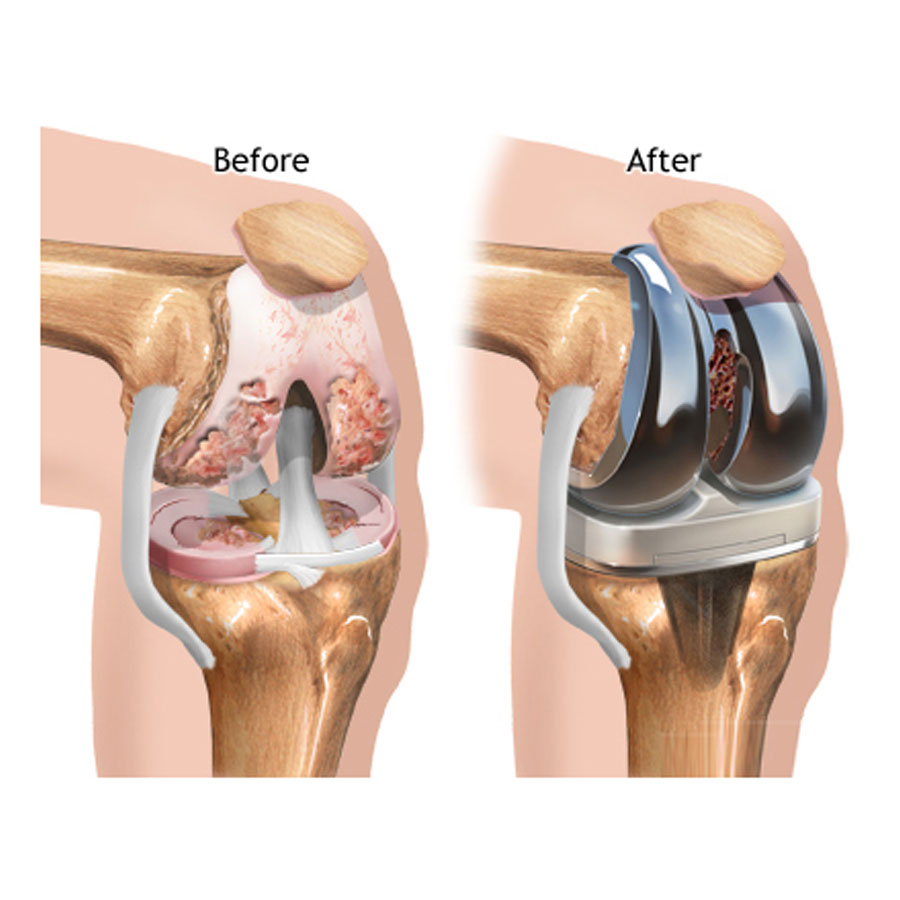 Joint Replacement Surgeries