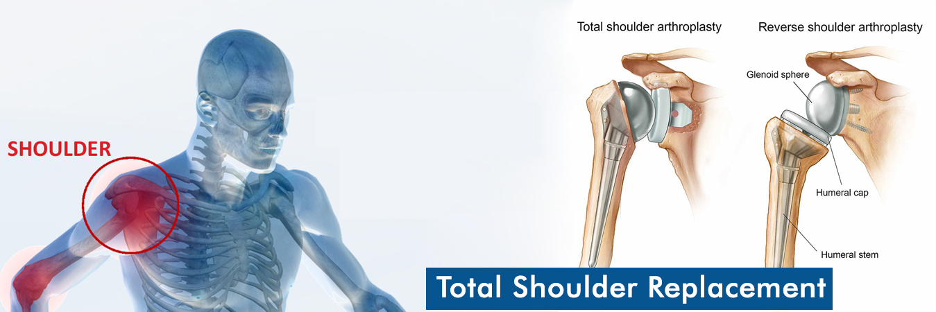 Best Shoulder Replacement Surgery In Jaipur