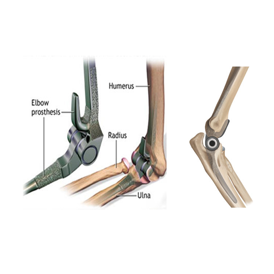 Best Joint Replacement Surgeon Jaipur